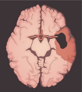 Brain damage due to a stroke