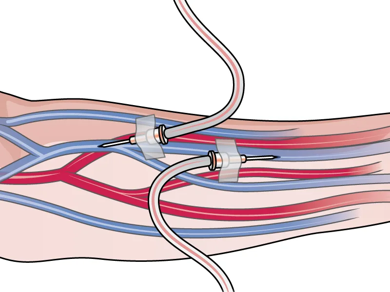 Medical illustration showing vascular access anatomy and fistula-related clinical procedures.